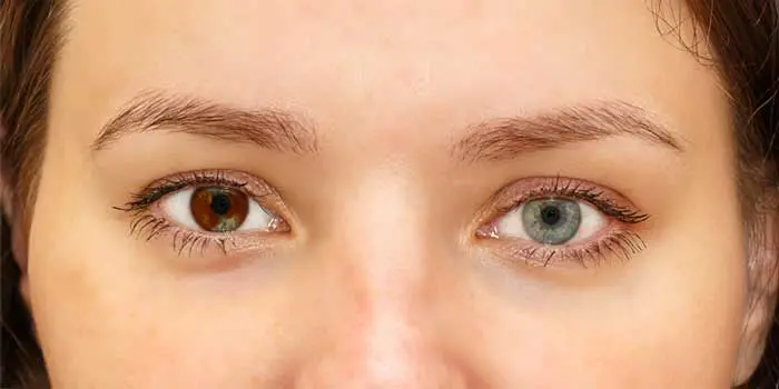 چه زمانی عمل تغییر رنگ چشم جنبه درمانی دارد؟