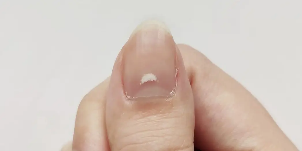 لکه‌های سفید روی ناخن‌ها چه معنایی دارند؟
