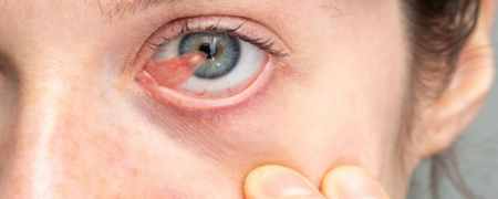 ناخنک چشم چیست؟ آیا روشی خانگی برای درمان ناخنک چشم وجود دارد؟