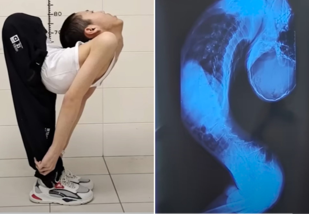نزدیک شدن «پسر تا شده» به ایستادن پس از جراحی صاف کردن ستون فقراتش + ویدیو