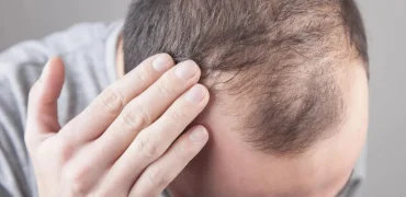 آینده درمان ریزش مو اینجاست؛ رویش مجدد و درمان طاسی سر با استفاده از یک قند خاص
