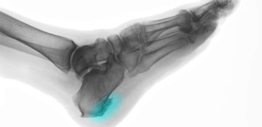 خار پاشنه چیست؟ بررسی جامع علل، علائم و راه‌های درمان