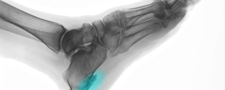 خار پاشنه چیست؟ بررسی جامع علل، علائم و راه‌های درمان