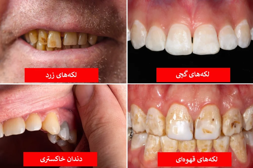 رنگ دندان از دیدگاه علم چه چیزهایی درباره سلامت شما می‌گوید؟