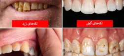 رنگ دندان از دیدگاه علم چه چیزهایی درباره سلامت شما می‌گوید؟