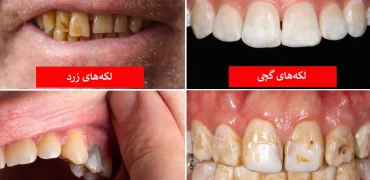 رنگ دندان از دیدگاه علم چه چیزهایی درباره سلامت شما می‌گوید؟