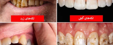 رنگ دندان از دیدگاه علم چه چیزهایی درباره سلامت شما می‌گوید؟