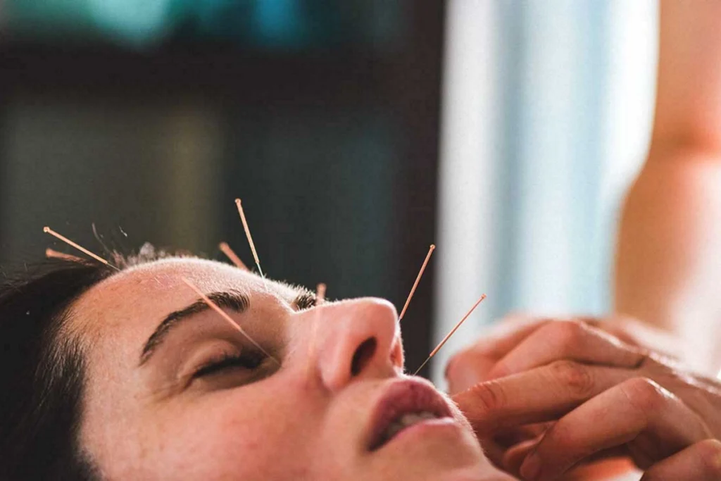 طب سوزنی صورت؛ روشی طبیعی برای جوانسازی پوست