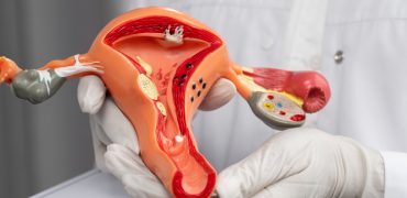 همه چیز درباره علائم، دلایل و عوارض کیست پارااواریان