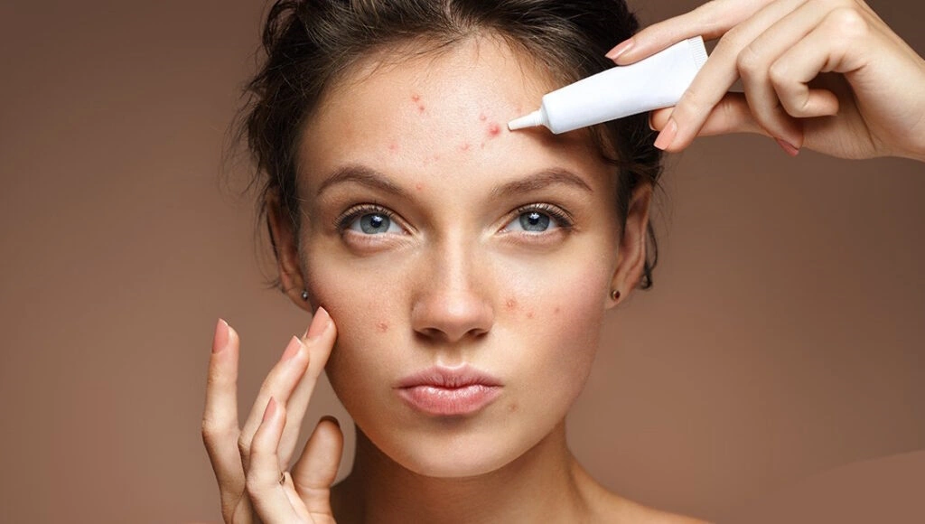 درمان آکنه بدون دارو