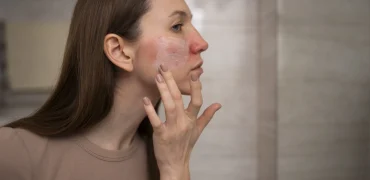 روتین ۱۵ دقیقه‌ای پوست؛ چطور آکنه را بدون دارو از بین ببریم؟