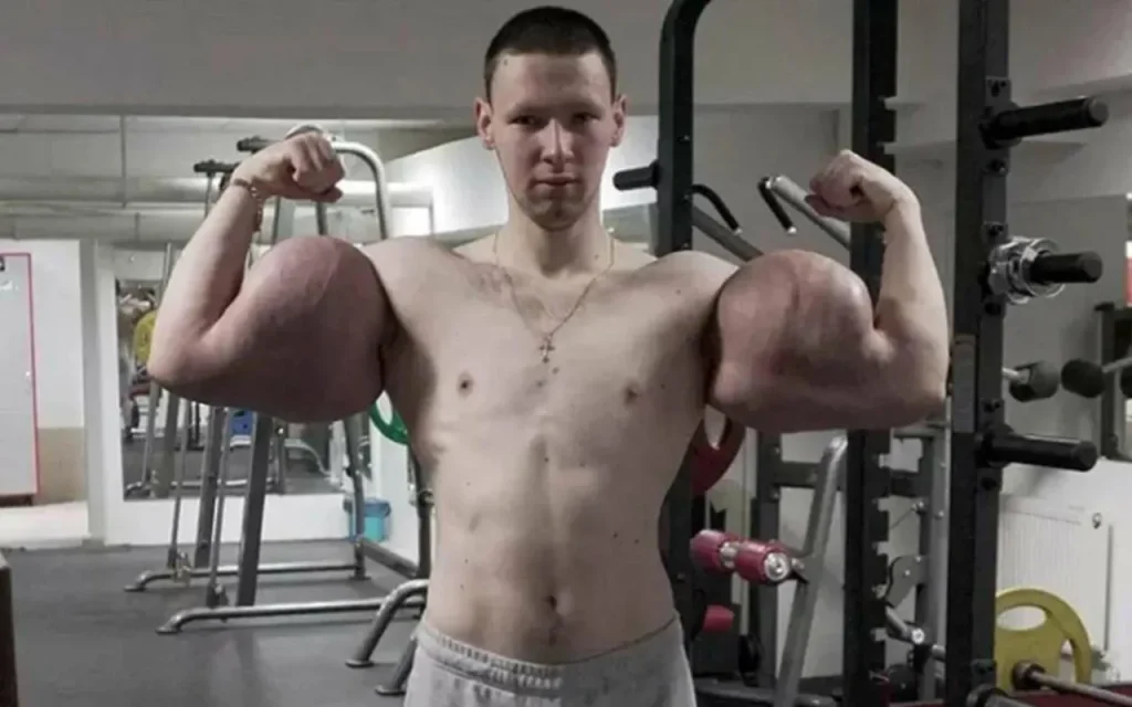 بدنساز ۲۹ ساله روس در آستانه قطع هر دو دست به دلیل تزریق ژل به عضلاتش