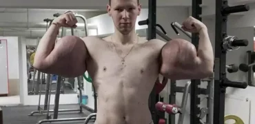 بدنساز ۲۹ ساله روس در آستانه قطع هر دو دست به دلیل تزریق ژل به عضلاتش