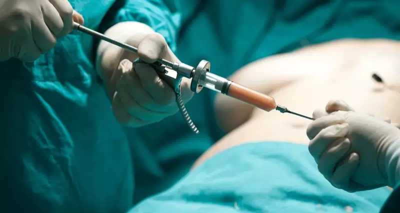 موج پشیمانی از عمل لیفت باسن برزیلی؛ چرا BBL پرریسک‌ترین جراحی ۲۰۲۵ شد؟