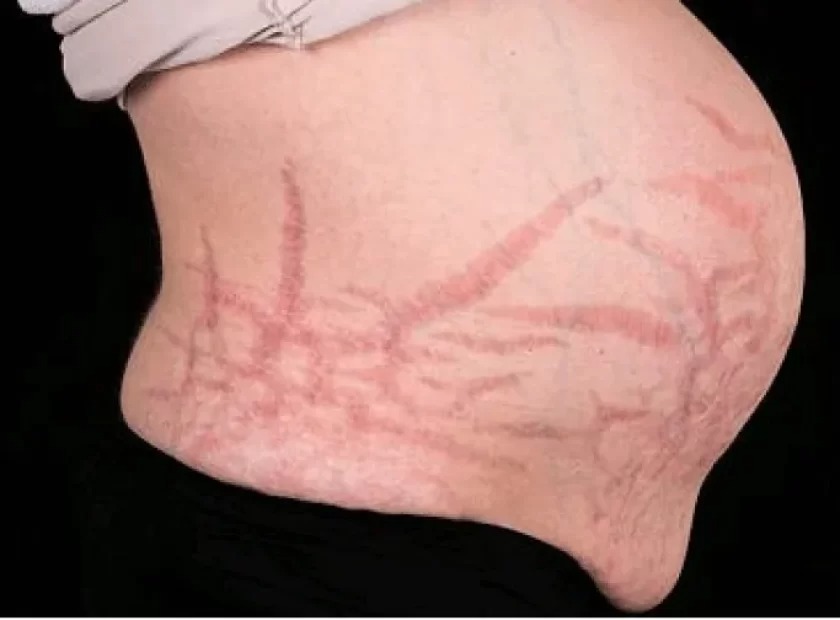 سندرم کوشینگ