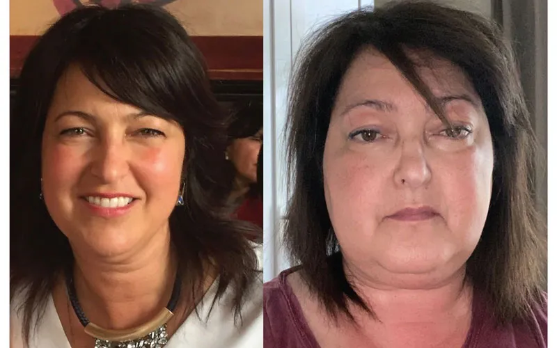 سندرم کوشینگ