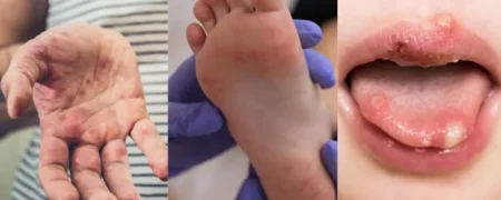 آیا تب برفکی در انسان خطرناک است؟ تفاوت آن با تب برفکی حیوانات را بدانید!