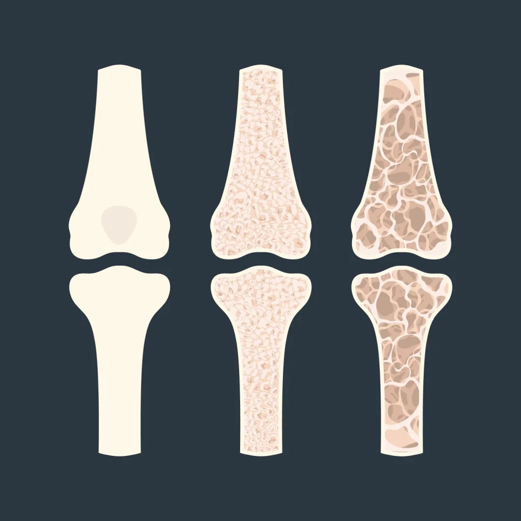 آسیب به استخوان‌ها