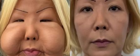 جراحی ترمیم چهره اینفلوئنسر معروف برزیلی پس از عمل زیبایی ناموفق در سال ۲۰۱۷