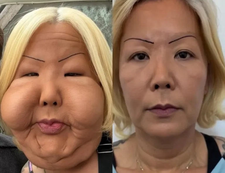 جراحی ترمیم چهره اینفلوئنسر معروف برزیلی پس از عمل زیبایی ناموفق در سال ۲۰۱۷