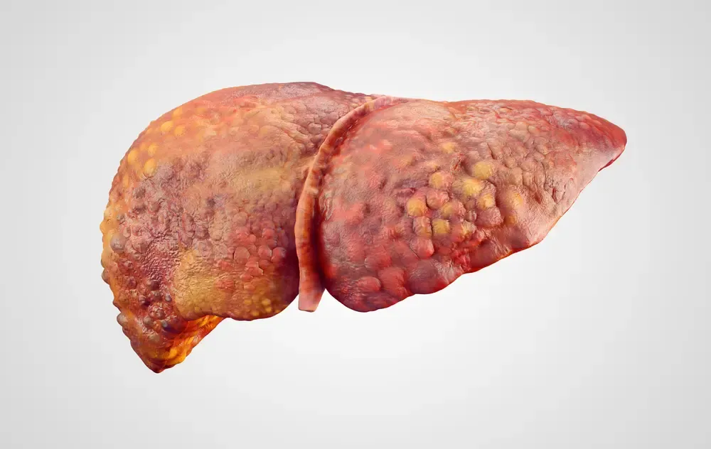 liver-cirrhosis-2.webp
