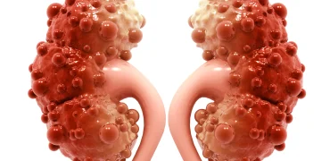 چرا کیست کورتیکال کلیه ایجاد می‌شود و چه زمانی خطرناک است؟