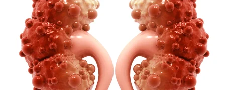 چرا کیست کورتیکال کلیه ایجاد می‌شود و چه زمانی خطرناک است؟