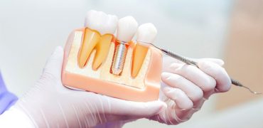 ایمپلنت اقساطی دندان با بهترین مواد و متخصص در شهریار