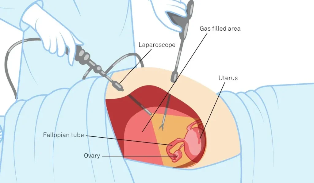 تفاوت لاپاراسکوپی با جراحی باز و نکات مهم دوران نقاهت