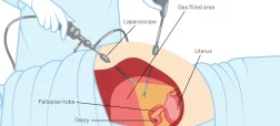 تفاوت لاپاراسکوپی با جراحی باز و نکات مهم دوران نقاهت