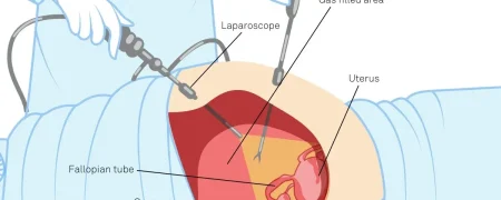 تفاوت لاپاراسکوپی با جراحی باز و نکات مهم دوران نقاهت