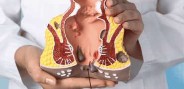 شقاق مقعدی چیست و چرا ایجاد می‌شود؟ بررسی علائم و روش‌های درمان