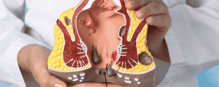 شقاق مقعدی چیست و چرا ایجاد می‌شود؟ بررسی علائم و روش‌های درمان