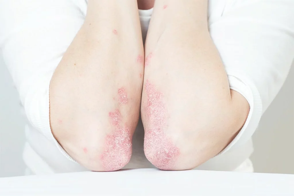 کاهش ۳۰ درصدی خطر پسوریازیس با یک عادت ساده در سبک زندگی