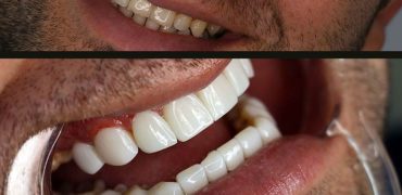 لمینت بهتر است یا کامپوزیت و نکاتی که باید بدانید