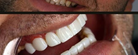 لمینت بهتر است یا کامپوزیت و نکاتی که باید بدانید