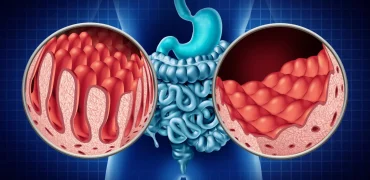 سلیاک چگونه روده را تخریب می‌کند؟ بررسی علل، علائم و راه‌های مدیریت این بیماری