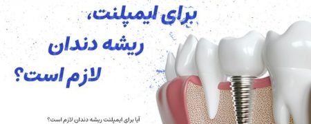 آیا برای ایمپلنت، ریشه دندان لازم است؟