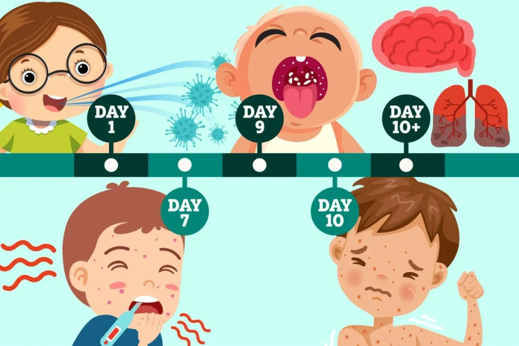 روند زمانی علائم مُسری‌ترین بیماری جهان؛ کودکان زیر ۵ سال در خطر ابتلا به سرخک