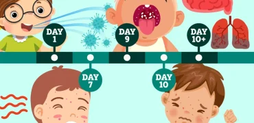 روند زمانی علائم مُسری‌ترین بیماری جهان؛ کودکان زیر ۵ سال در خطر ابتلا به سرخک