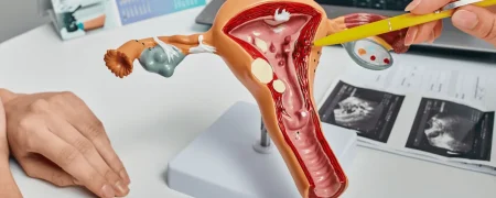 پولیپ رحم چیست؟ از علائم و دلایل ایجاد تا جدیدترین روش‌های درمان قطعی