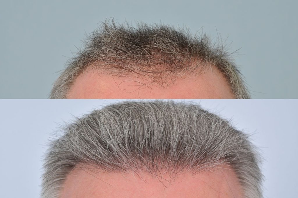 آیا کاشت موی جوگندمی امکان پذیر است؟