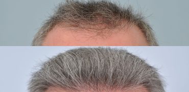 آیا کاشت موی جوگندمی امکان پذیر است؟