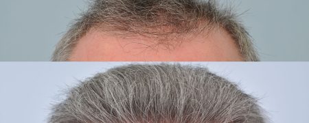 آیا کاشت موی جوگندمی امکان پذیر است؟