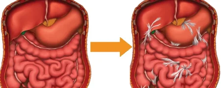 با علائم، علل و راه‌های تشخیص چسبندگی روده آشنا شوید