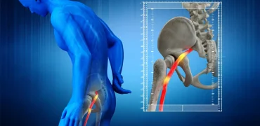روش‌های غیردارویی درمان سیاتیک؛ از تحرک تا اصلاح سبک زندگی