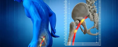 روش‌های غیردارویی درمان سیاتیک؛ از تحرک تا اصلاح سبک زندگی