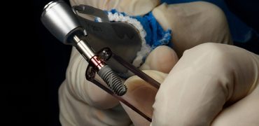 ایمپلنت دندان؛ بهترین راه ‌حل جایگزینی دندان از دست ‌رفته با حفظ زیبایی لبخند