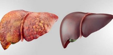 تشخیص کبد چرب با آزمایش خون یا سونوگرافی؟ کدام بهتر است؟