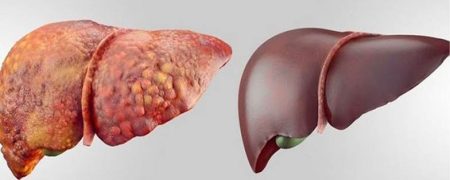 تشخیص کبد چرب با آزمایش خون یا سونوگرافی؟ کدام بهتر است؟